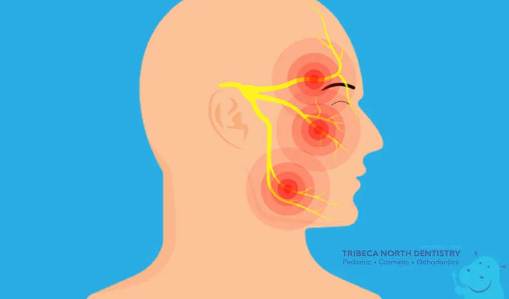 How the Trigeminal Nerve Spreads Pain