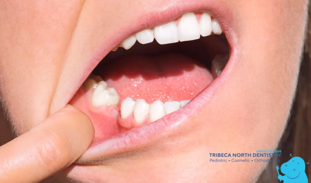 Tooth Pain After Tooth Pulled